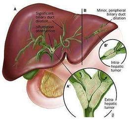 胆管细胞癌吃瓜,胆管细胞癌的饮食与预防